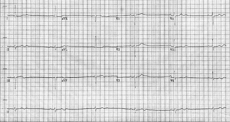 Parameswaran - Figure 3A. Resting 12-lead electrocardiogram (ECG) from case 1.