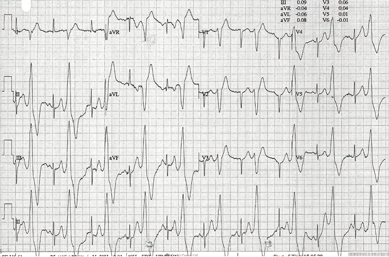 Parameswaran - Figure 3G. Exercise test from case 2 showing ventricular bigeminy in early exercise