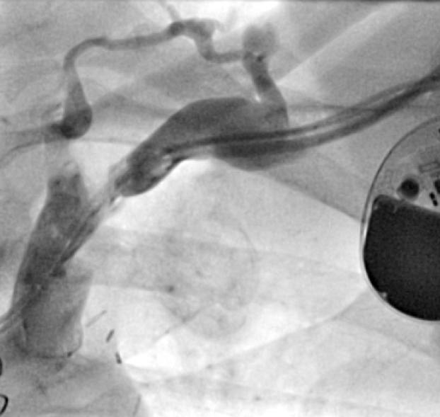 Shah - Figure 1. Venogram showing stenotic segment of subclavian vein (postero-anterior view)