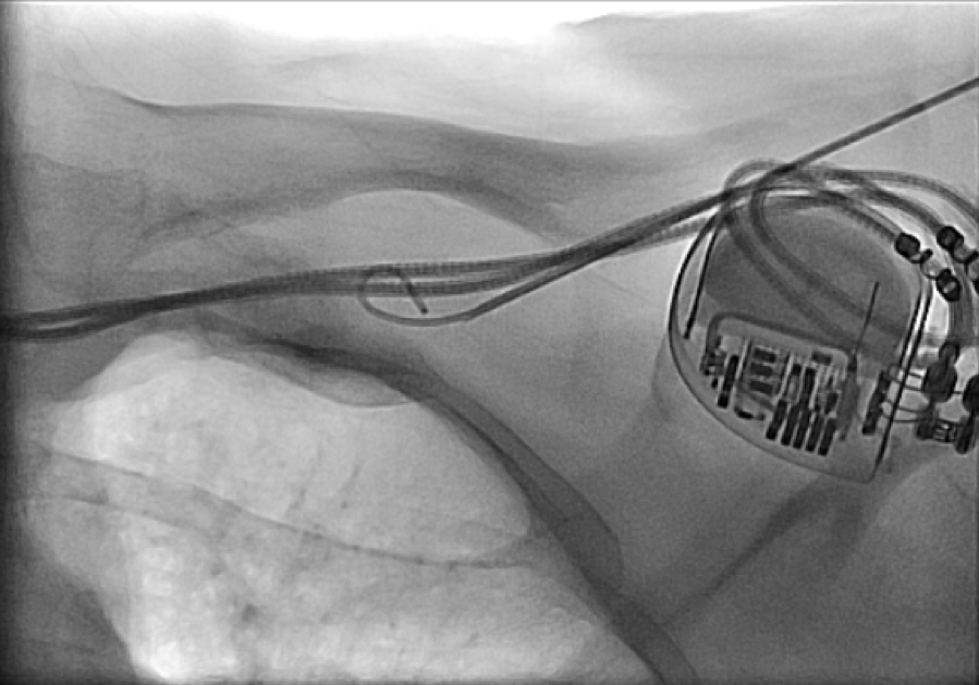 Shah - Figure 2. Introducer needle and guidewire advancement in subclavian vein (postero- anterior view with caudal angulation)