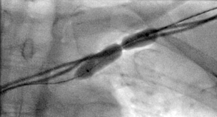 Shah - Figure 4. An 8 mm × 40 mm Armada™ angioplasty balloon inflation in a stenotic segment of subclavian vein with waisting of the inflated balloon (postero-anterior view)