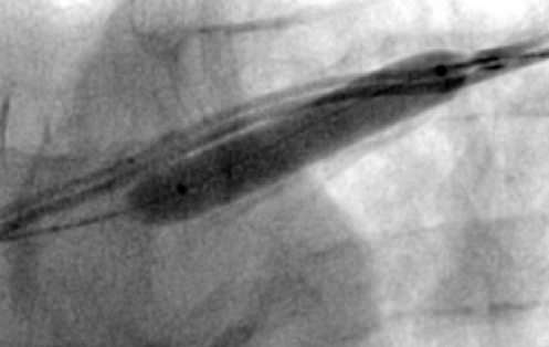 Shah - Figure 5. An 8 mm × 40 mm Armada™ angioplasty balloon inflation in a stenotic segment of the subclavian vein with complete expansion of the balloon (postero-anterior view)