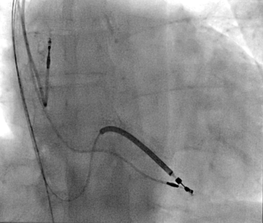 Shah - Figure 6. Newly implanted implantable cardioverter-defibrillator lead (postero-anterior view)