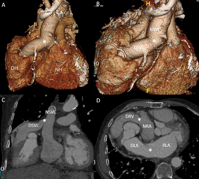 Ahmed - Figure 1. Electrocardiogram-gated cardiac computed tomography three-dimensional image (A) demonstrating the intrathoracic location of the donor heart (DH) on the right and native heart (NH) on the left with the donor aorta (DA) anastomosed (white star) with the native ascending aorta (NA); three-dimensional image (B) and multi-planar reconstruction (C) images of donor superior vena cava (DSVC) connected to the native superior vena cava (NSVC); and multi-planar reconstruction (D) demonstrating donor right ventricle (DRV) anastomosed via the donor pulmonary artery to the native right atrium (NRA), and the donor left atrium (DLA) to the native left atrium (RLA). All anastomoses are depicted by white stars