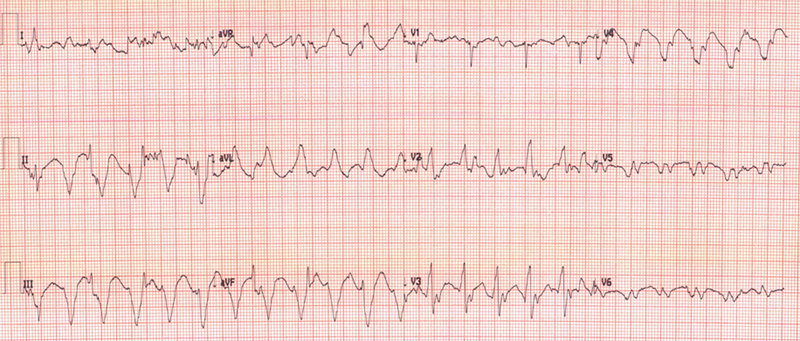 Ahmed - Figure 2. Native heart ventricular tachycardia. Standard 12-lead electrocardiogram. Precordial leads V2–6 depict a monomorphic broad-complex tachycardia compatible with native heart ventricular tachycardia