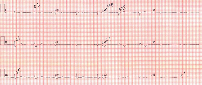 Ahmed - Figure 3. Native heart asystole. V1 swapped for right-sided V6 (V6R). Electrocardiogram (ECG) shows a low-amplitude QRS complex progressively decreasing through the precordial leads from V2–V6. V6R shows a sinus bradycardia. This ECG is in keeping with native heart asystole and donor heart sinus bradycardia of a rate of 54 beats per minute