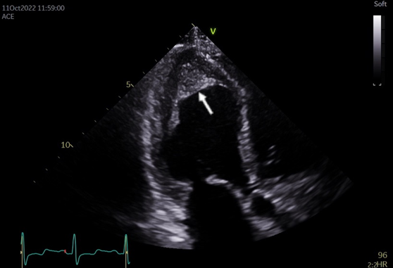 Cooke - Figure 1. Transthoracic echocardiogram. Apical thrombus indicated by the white arrow