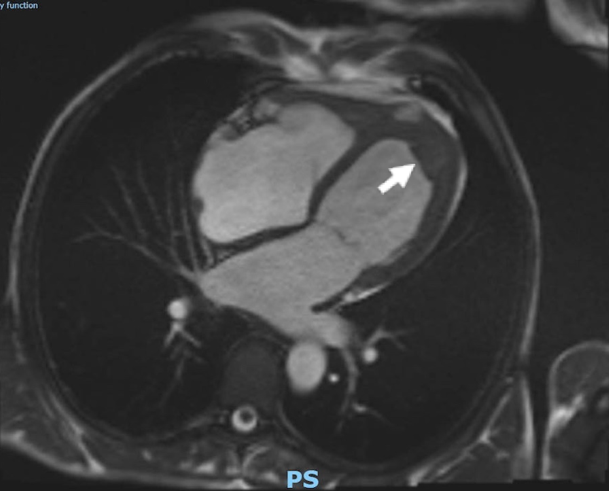 Cooke - Figure 2. Cardiac magnetic resonance image. Apical thrombus indicated by the white arrow