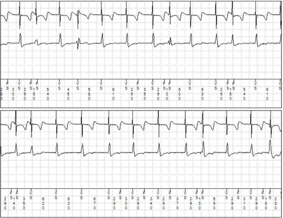 Khalil - Figure 1. Figure 1: Electrogram tracing demonstrating the T-wave oversensing (TWOS). The majority of intrinsic ventricular depolarisations are correctly identified by the device as ventricular sensed (VS) events, but the TWOS leads to incorrect attribution of these repolarisation signals as high-rate ventricular fibrillation-sensed (Fs) events. This in turn leads to misinterpretation of premature ventricular complexes as Fs rather than Vs events