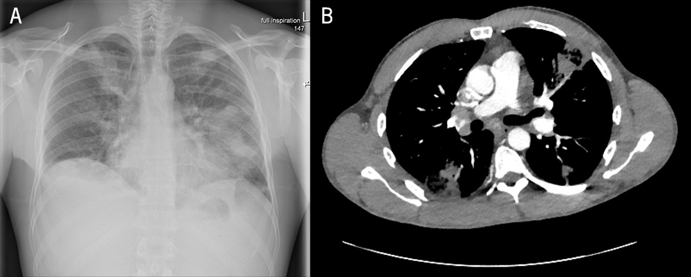 Baral - Figure 1. A. Chest X-ray demonstrating multifocal pneumonia. B. Computed tomography of the chest (axial view) demonstrating multifocal cavitating pneumonia