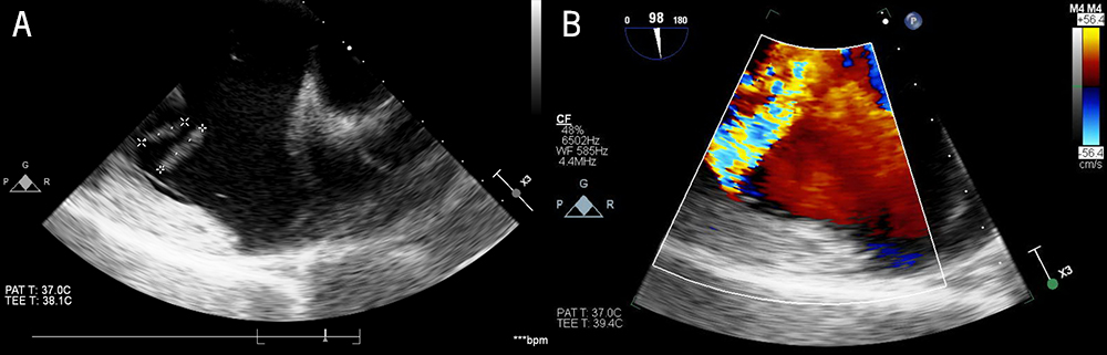 Baral - Figure 2. A. Transoesophageal echocardiogram demonstrating two vegetations in the tricuspid valve. B. Colour Doppler analysis during transoesophageal echocardiogram demonstrating severe regurgitation through the tricuspid valve