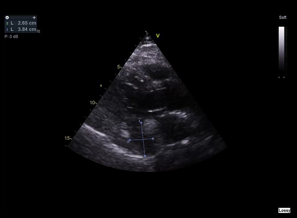 Wu - Figure 1. Transthoracic echocardiography demonstrates a mass adjacent to the descending aorta measuring approximately 4 cm × 3 cm