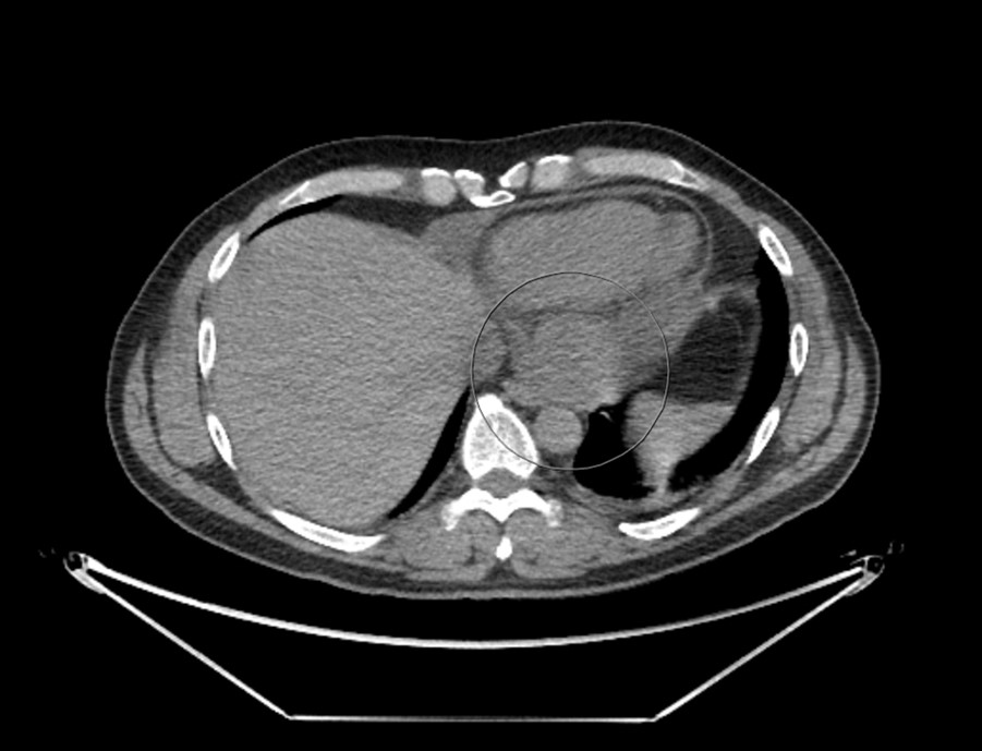 Wu - Figure 2. Contrasted chest computed tomography scan demonstrates an oval 7 cm × 8 cm calcified soft tissue mass in the posteroinferior aspect of the mediastinum