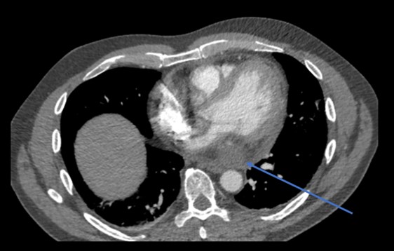 Wu - Figure 3. Another cross-sectional window of the chest CT; the blue arrow points to the oval soft tissue mass in the posteroinferior aspect of the mediastinum