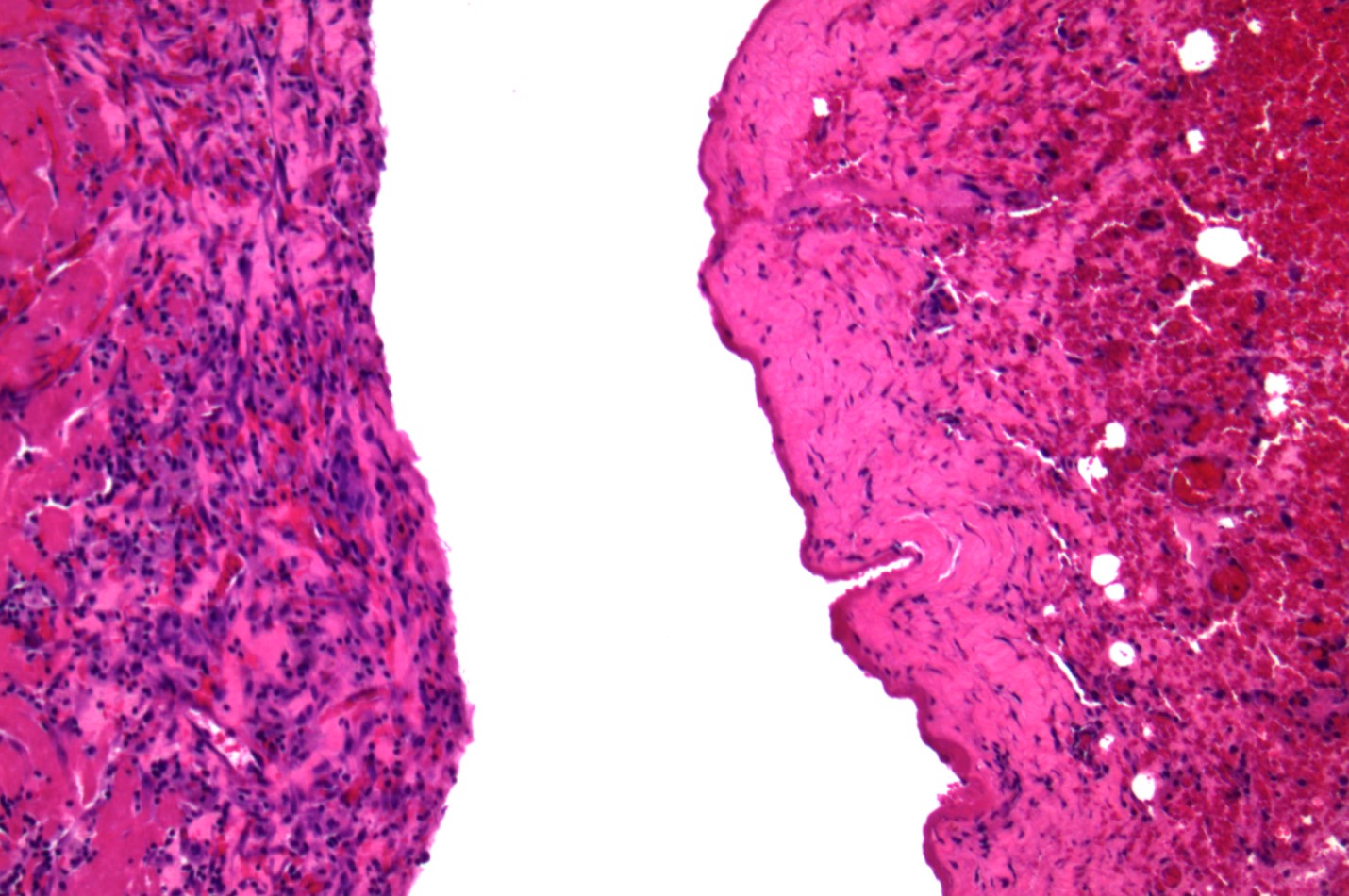 Wu - Figure 4. Histological examination of the cyst wall suggestive of fibrosis with neither evidence of malignancy nor an infective pathogen