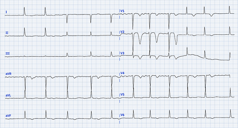 Khan - Figure 1. Admission electrocardiogram (ECG) demonstrating Wellens’ syndrome type B. Key characteristics: deeply inverted symmetrical T-waves in leads V1–V5, hallmark of Wellens’ type B; atrial fibrillation (irregular rhythm, no P-waves); heart rate 66 bpm; normal QRS (92 ms); prolonged QTc (496 ms); normal axis (+35°). These findings, especially precordial T-wave inversions, suggest critical proximal left anterior descending (LAD) stenosis