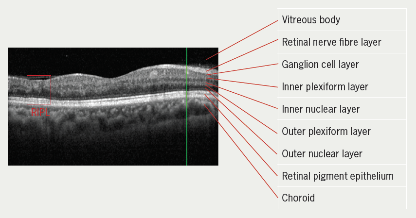 Yeo - Figure 1. Spectral domain optical coherence tomography (SD-OCT) scan shows two retinal ischaemic perivascular lesions (RIPL) demonstrating an ‘M’ shape on patient 4. The superior points of the letter ‘M’ coincide with the outpouching of outer nuclear layer along with narrowing of the inner nuclear layer