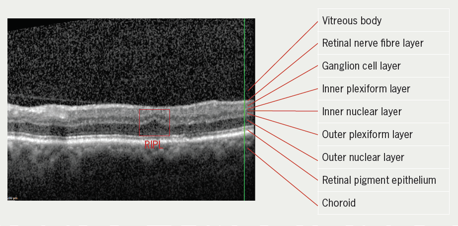 Yeo - Figure 2. SD-OCT demonstrates one RIPL lesion of patient 11, with focal thinning of the inner nuclear layer and associated outer nuclear layer upward expansion and displacement of the outer plexiform layer