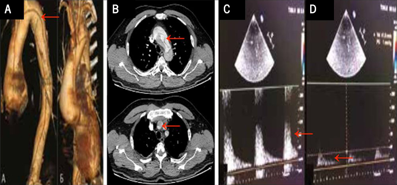 Elias - Figure 1. A and B. Pre-operative computed tomography (CT) angiography showing type A aortic dissection with involvement of the aortic arch branches. 
C and D. Matas test: transcranial Doppler ultrasound showing change in blood flow velocity of the right middle cerebral artery before (C) and after (D) compression of right common carotid artery (RCCA)