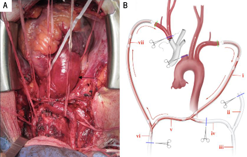 Elias - Figure 2. A. Access of aorta and its branches after median sternotomy showing aortic enlargement (black arrow). B. Circuit depicting bihemispheric cerebral perfusion along the off-pump axillo-axillary shunt: (i) cannula to left axillary artery (LAA), which is also connected to both the cardiopulmonary bypass (CPB) and head pumps. It operates in off-pump mode during branch-first stages; (ii) cannula from the CPB pump to be connected to the aortic tube graft to augment systemic circulation after distal aortic anastomosis; (iii) arterial cannula to the CPB pump; (iv) cannula connecting the CPB pump to the perfusion circuit; (v) cannula from head pump to the circuit; (vi) arterial cannula to the head pump; (vii) cannula from the head pump to right axillary artery (RAA)