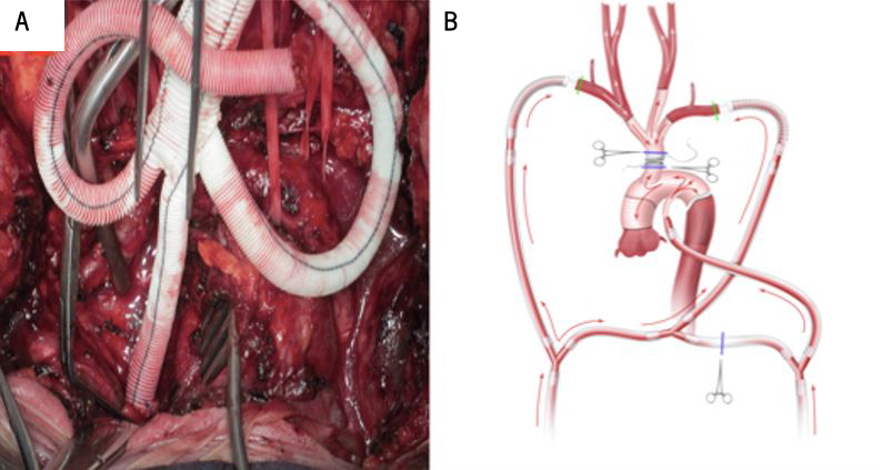 Elias - Figure 3. A. Trifurcation graft (Bakulev Scientific Center of Cardiovascular Surgery, Moscow, Russia) for branch-first stage of the total aortic replacement. B. Completed branch-first total aortic replacement. The common stem of the trifurcation arch graft is anastomosed in an end-to-side to a hole in the tube graft corresponding to the new ascending aorta. Cerebral perfusion is maintained throughout the aortic reconstruction