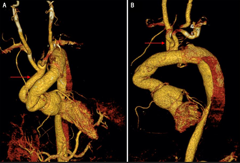 Elias - Figure 4. A and B. Postoperative CT angiography showing a complete repair of the aortic dissection using the branch-first technique