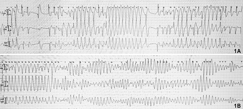 Singh - Figure 1. A) Intermittent self-terminating non-sustained polymorphic ventricular tachycardia (PMVT) with palpitations. B) Sustained PMVT requiring defibrillation