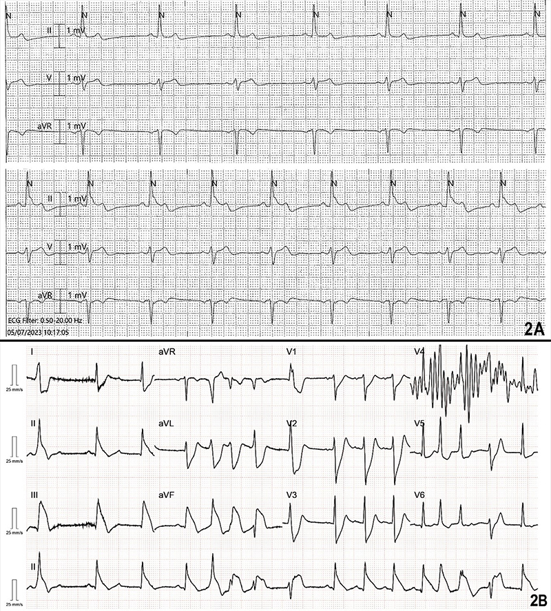 Singh - Figure 2. A) Transient ST elevation in lead II on telemetry. B) ‘Shark fin’ waveform in the inferior leads on 12-lead electrocardiogram (ECG)