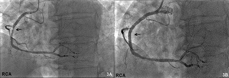 Singh - Figure 3. Right coronary artery (RCA) unchanged mid-vessel stenosis on second coronary angiogram (A). RCA appearance post-stent insertion (B)