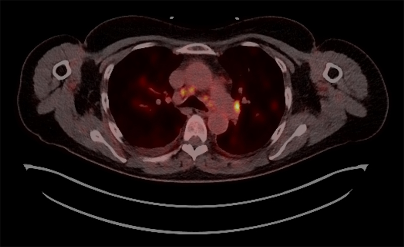 Nair - Figure 3. Positive electron tomograph scan showing significant fluorodeoxyglucose uptake consistent with extensive active cardiac sarcoidosis