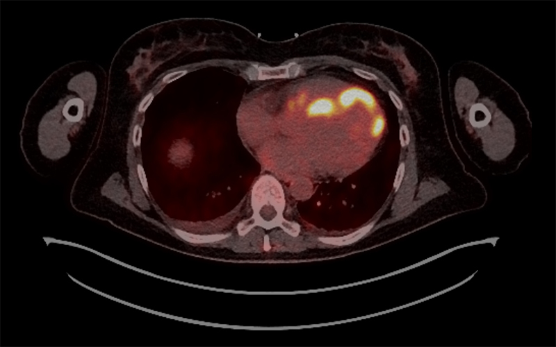 Nair - Figure 4. Positive electron tomograph scan confirming active lymph node involvement in sarcoidosis