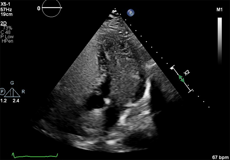 Walker - Figure 1. Transthoracic echocardiogram from bubble study showing microbubbles have completely filled the left heart chambers, confirming a right-to-left shunt