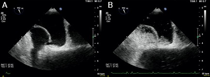 Walker - Figure 2. A: transoesophageal echocardiogram showing a 40 mm patent foramen ovale. B: transoesophageal echocardiogram showing large numbers of microbubbles crossing the interatrial septum when the patient was positioned at 45 degrees