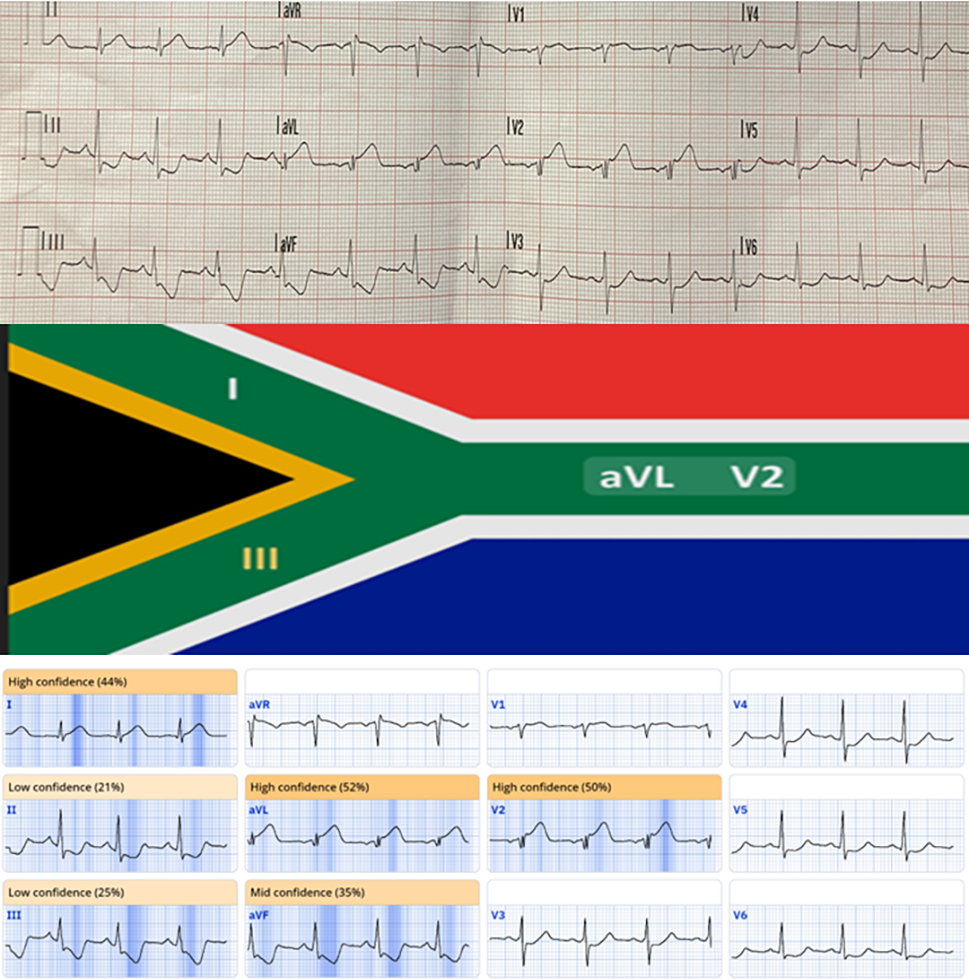Dali - Figure 1. A. Standard 12-lead electrocardiogram (ECG) showing sinus rhythm, ST-segment elevation in leads aVL and V2, with depression in the inferior leads II, III and aVF. B. South African flag pattern associated with high lateral occlusive myocardial infarction (OMI) illustrating ST-elevation in leads I, aVL and V2 with ST-depression in lead III. C. Artificial intelligence (AI)-augmented ECG interpretation reporting high confidence of OMI. The AI algorithm (PM Cardio OMI AI ECG Model, www.powerfulmedical.com) highlights the leads where significant abnormalities are detected and reports the level of confidence in diagnosis of OMI