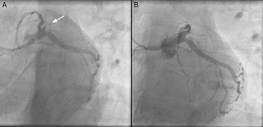 Dali - Figure 2. A. Left coronary system angiogram, left anterior oblique (LAO) caudal view (‘deuce’ view 40,40) showing occluded ostial intermediate artery (white arrow). B. LAO caudal view (standard 40,30) not steep enough to show the occlusion