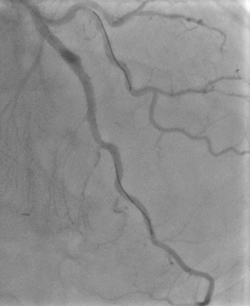 Safdar - Figure 5. Flow remained adequate post-stent placement