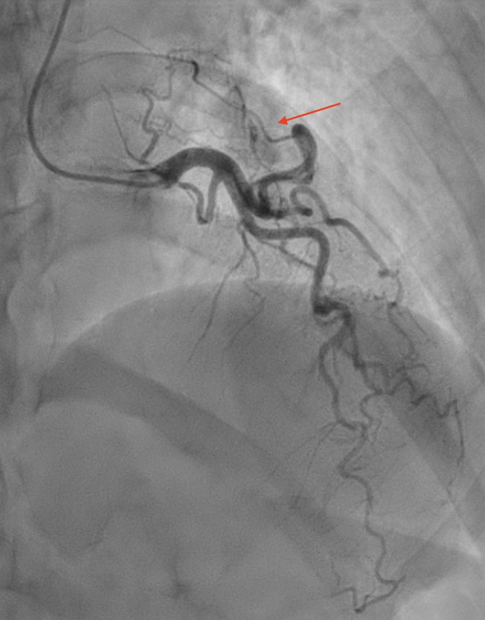 Offiah - Figure 1. Right anterior oblique (RAO) cranial view of the left coronary artery. The red arrow denotes the fistulous connection between the coronary and pulmonary artery in all figures