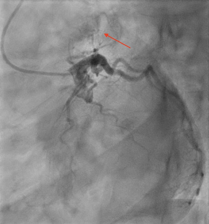 Offiah - Figure 2. Left anterior oblique (LAO) caudal view of the left coronary artery