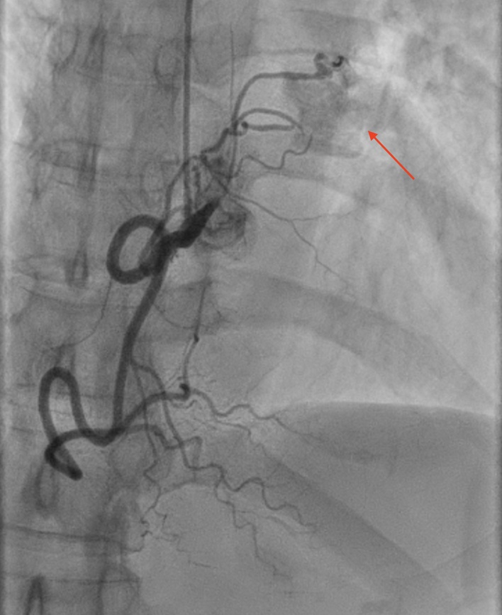 Offiah - Figure 3. Anterior-posterior (AP) cranial view of the right coronary artery