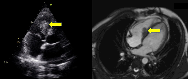 Carvalho - Figure 1. Case 1. Transthoracic echocardiography (TTE) and cardiac magnetic resonance imaging (MRI) reveal a mass adherent to the interventricular septum, measuring 26.8 × 18.8 mm at its largest dimensions, protruding into the right ventricular cavity