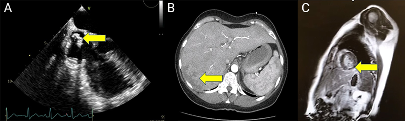 Carvalho - Figure 2. Case 2. A. TTE reveals a mass in the superior vena cava extending into the right atrium. B. Thoraco-abdominal computed tomography (CT) excluded pulmonary thromboembolism and revealed findings consistent with hepatic infarction. C. Cardiac MRI with late gadolinium enhancement (subendocardial) in the basal inferolateral and inferoseptal walls suggests an embolic event