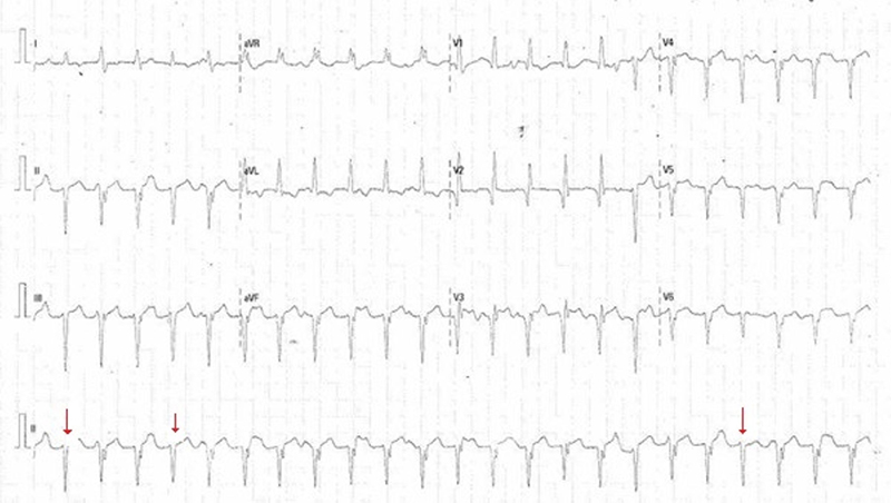 Elhadi - Figure 1. 12-lead electrocardiogram (ECG) showing sustained slow ventricular tachycardia (VT). Red arrows indicate ‘capture beats’