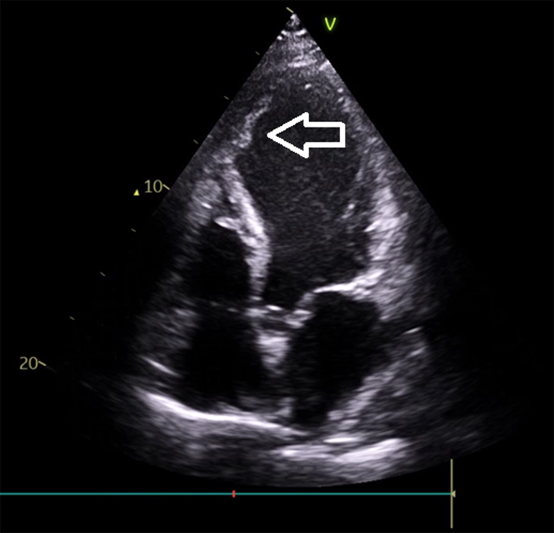 Elhadi - Figure 2. Apical 4-chamber view echocardiogram showing left ventricular (LV) thrombus