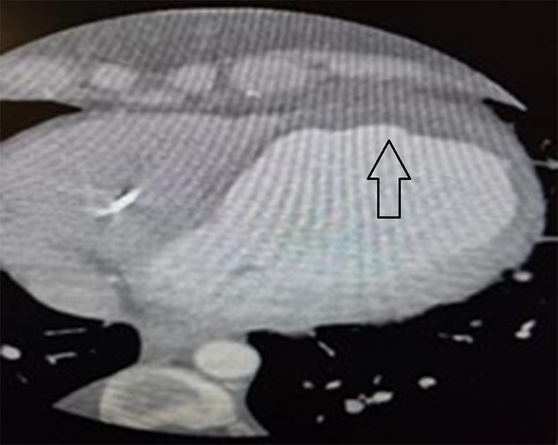 Elhadi - Figure 3. Cardiac computed tomography (CT) demonstrating LV thrombus