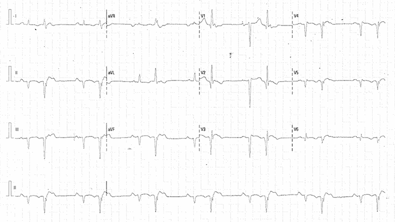 Elhadi - Figure 4. 12-lead ECG showing ventricular bigeminy