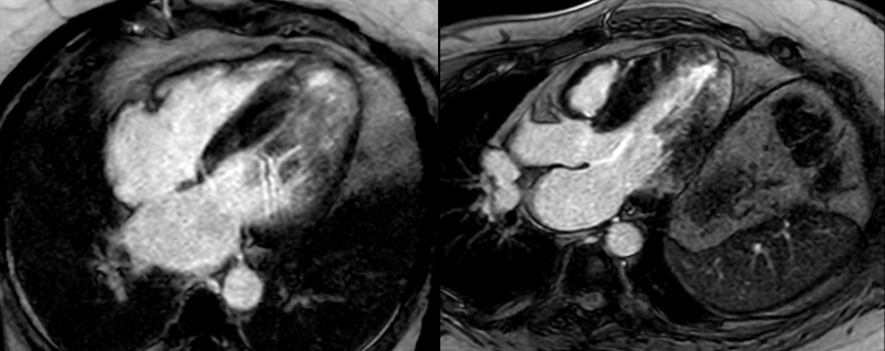 Chatterjee - Figure 1. Cardiac magnetic resonance (CMR) four-chamber and three-chamber late gadolinium enhancement (LGE) phase-sensitive inversion recovery (PSIR) showing asymmetric septal hypertrophy and patchy fibrosis