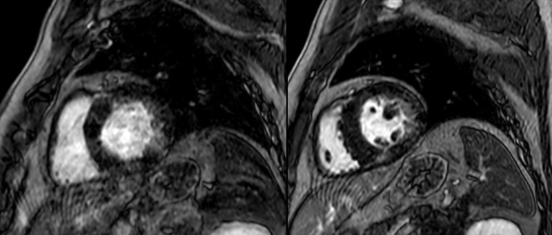 Chatterjee - Figure 2. CMR base to mid-cavity left ventricle (LV) short-axis LGE PSIR showing patchy mid-wall fibrosis
