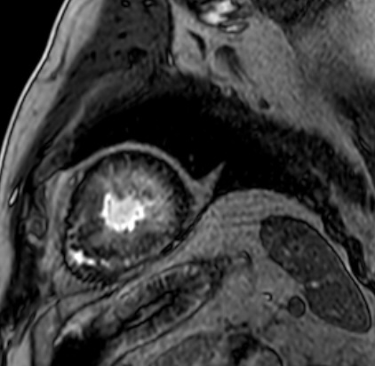 Chatterjee - Figure 3. CMR apical short-axis LGE PSIR showing near confluent and circumferential subendocardial and mid-wall fibrosis of the left ventricle