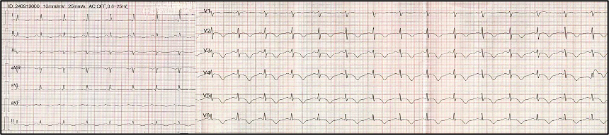Oflidis - Figure 1. ECG on day 1. Diffuse ST abnormalities in all limb and precordial leads with negative T waves