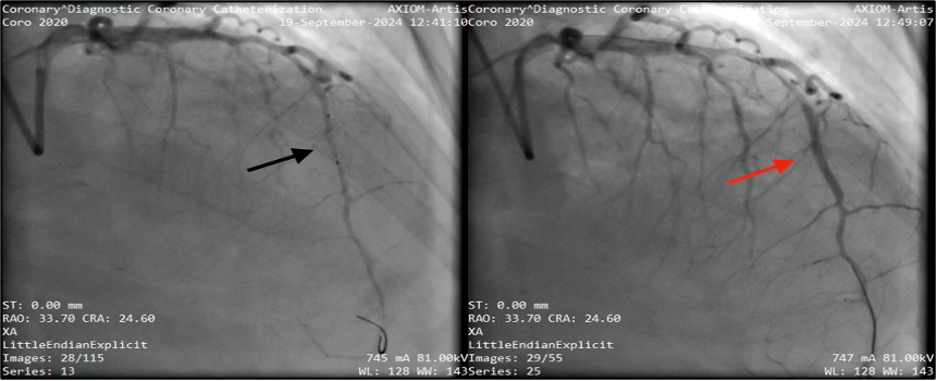 Oflidis - Figure 2. Left panel: Sequential stenotic lesions in the middle and distal parts of the left anterior descending coronary artery. Right panel: Angiographic result after successful deployment of a drug-eluting stent within the middle stenosis